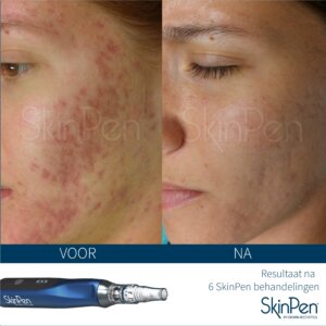Suzanne christis praktijk voor huidverzorging Venlo Skinpen